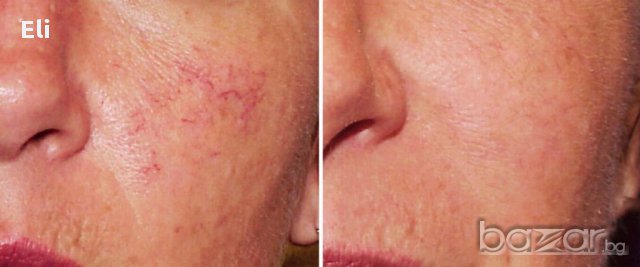 Крем"Розакс" за розацея, снимка 2 - Козметика - 17714377