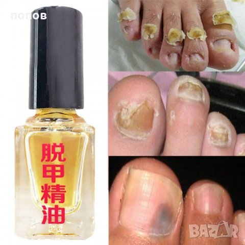 Лак против гъбички на ноктите 100% ефективно в Козметика за тяло в гр.  Ямбол - ID24758957 — Bazar.bg