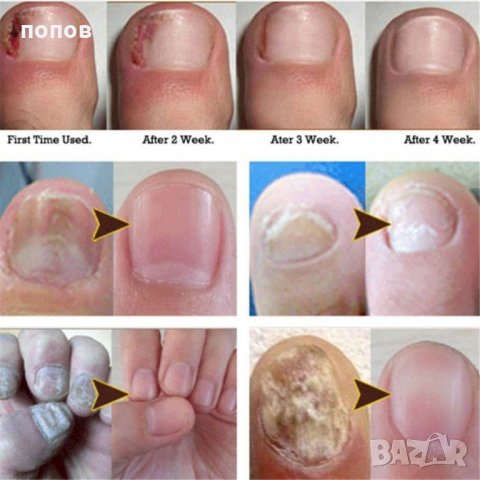 Лак против гъбички на ноктите 100% ефективно в Козметика за тяло в гр.  Ямбол - ID24758957 — Bazar.bg