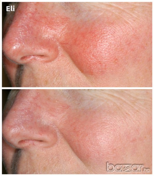 Крем"Розакс" за розацея, снимка 1