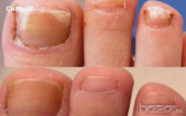 ГЪБИЧКИ - премахване! Възстановяване на деформирани нокти!, снимка 1