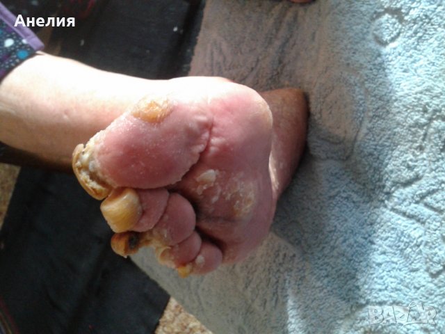 Медицински педикюр по домовете , снимка 5 - Медицински, стоматологични - 24454918