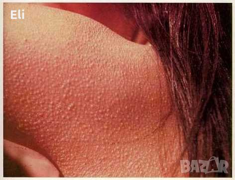 Лечебен мехлем при гъша кожа /кератозис пиларис/