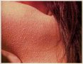 Лечебен мехлем при гъша кожа /кератозис пиларис/