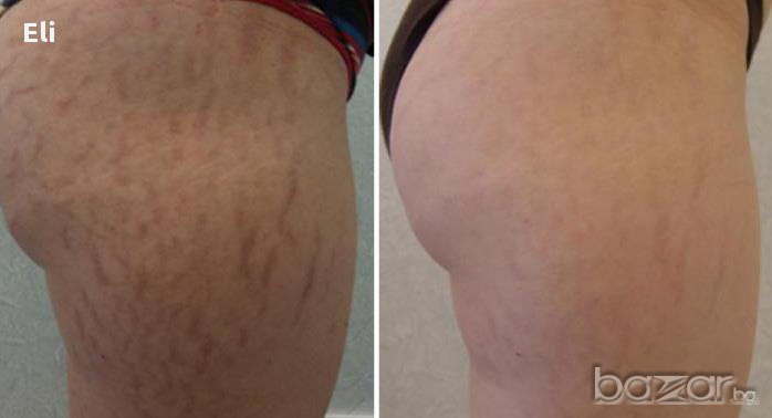 Крем против стрии с какаово масло, снимка 1