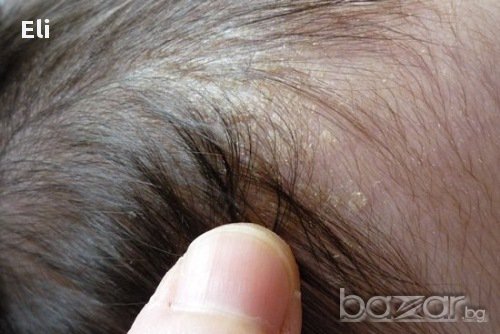 Билков концентрат против пърхот и себорея