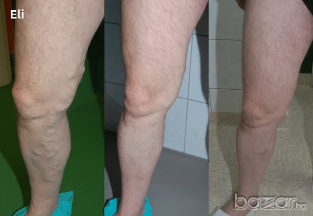 Билков мехлем при разширени вени