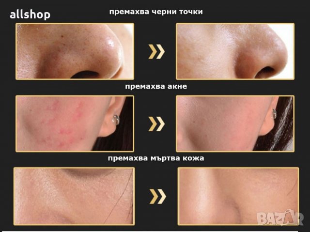 Вакуум уред против акне, черни точки, пъпки, комедони, снимка 4 - Козметика за лице - 24466371