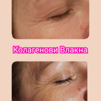 Подмладяващи процедури за лице, шия и ръце, снимка 1 - Друго - 44804337
