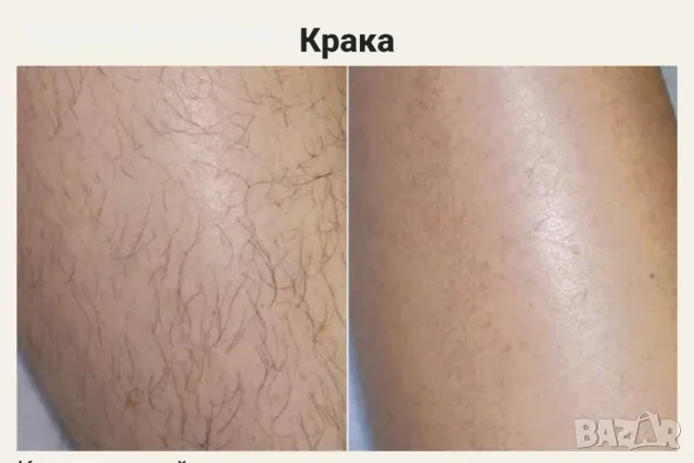Лазерна епилация , снимка 6 - Друго - 49438284