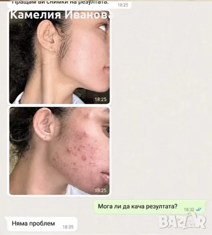 Крем против пъпки и петна