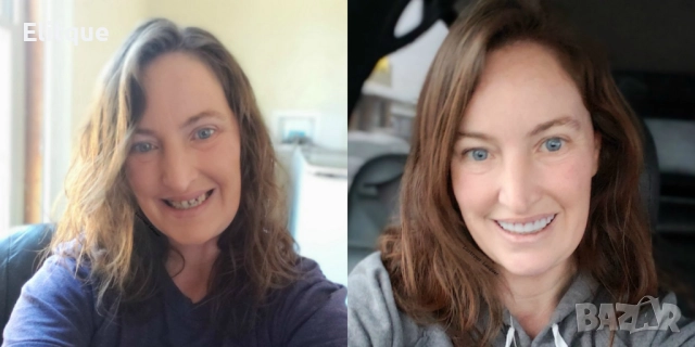 Instant Smile Lowers усмивка за минути  , снимка 14 - Други стоки за дома - 52906089