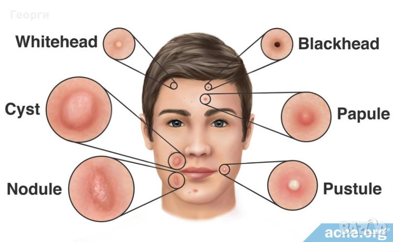 Грижа за лицето при акне, снимка 1