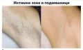 Лазерна епилация , снимка 4