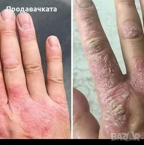 Пластири (Пейнлес) PAINLESS  налични! One More за определени заболявания, снимка 9 - Други - 36364317