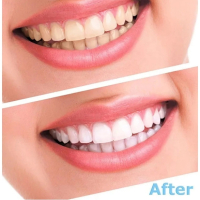 сет за избелване на зъби , снимка 2 - Други - 44679615