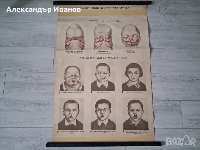 Стара табела,табло "Дефекти на лицето" 1964 г.