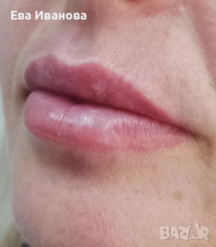 Безиглено уголемяване на устни с хиалурон 