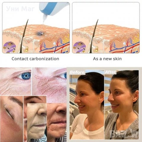 Плазмапен, Фибробласт, Козметичен Апарат за Фибробласт, Плазмолифтинг, Плазма Пен, лифтинг, снимка 3 - Козметични уреди - 33733969