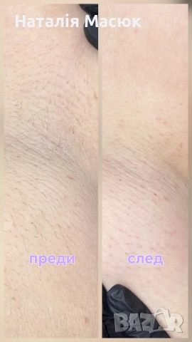 Електроепилация в Пловдив – Премахване на косми завинаги., снимка 3 - Друго - 52709676