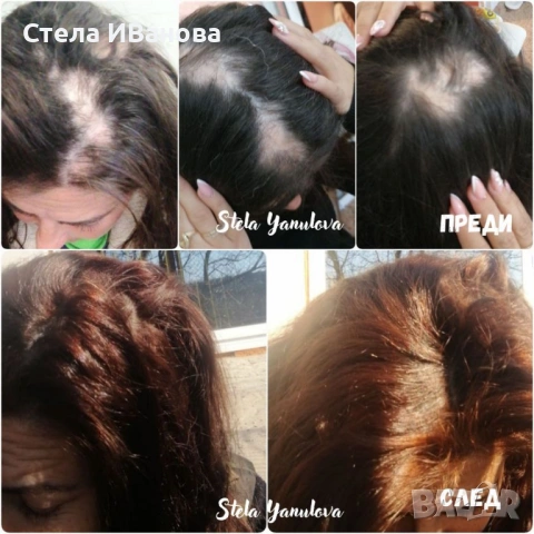 Комплект за бърз растеж на косата, при косопад, оплешивяване, алопеция, снимка 3 - Продукти за коса - 53222898