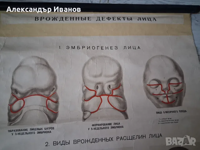 Стара табела,табло "Дефекти на лицето" 1964 г., снимка 2 - Здраве, медицина и спорт - 56138553