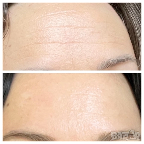 Ретинол Третиноин мелазмe хиперпигментация акне лице Acretin 0,025 0,05 , снимка 3 - Козметика за лице - 51942219