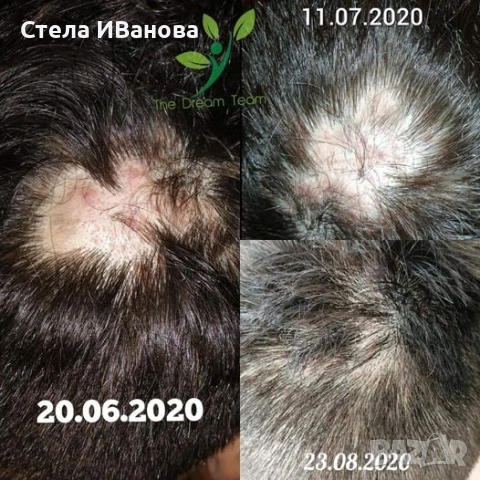 Комплект за бърз растеж на косата, при косопад, оплешивяване, алопеция, снимка 7 - Продукти за коса - 53222898