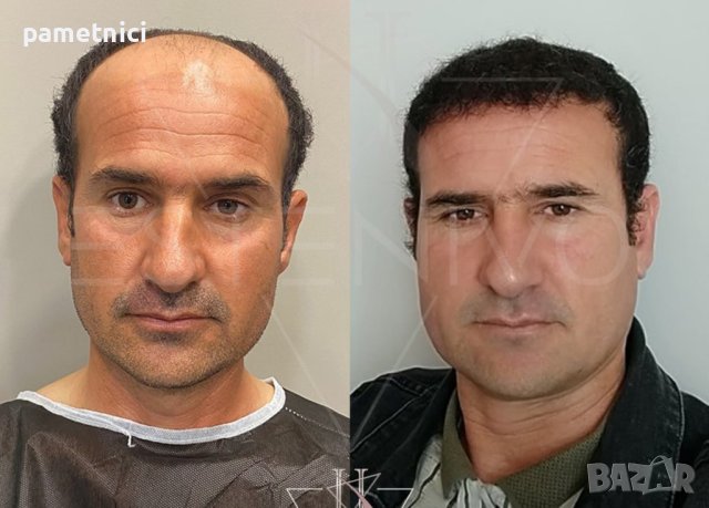 Присаждане на Коса Промоционална цена!, снимка 5 - Медицински, стоматологични - 26976880