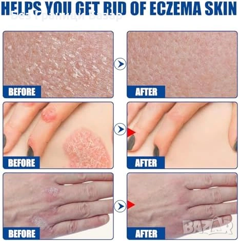 Нов Натурален крем при псориазис – без аромат, нежен към чувствителна кожа, снимка 6 - Други - 53368793