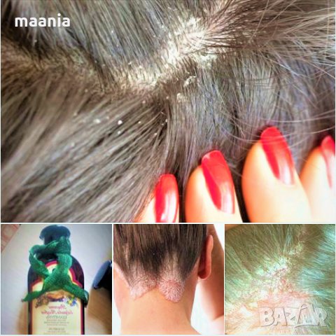 ПСОРИАЗИС, СЕБОРЕЯ, ПЪРХОТ, гъбички, ранички и екзема по главата, снимка 3 - Продукти за коса - 27299271