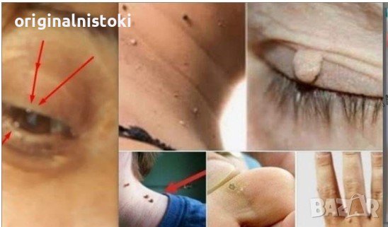 Премахва колкоши трън и папиломи бързо, снимка 1