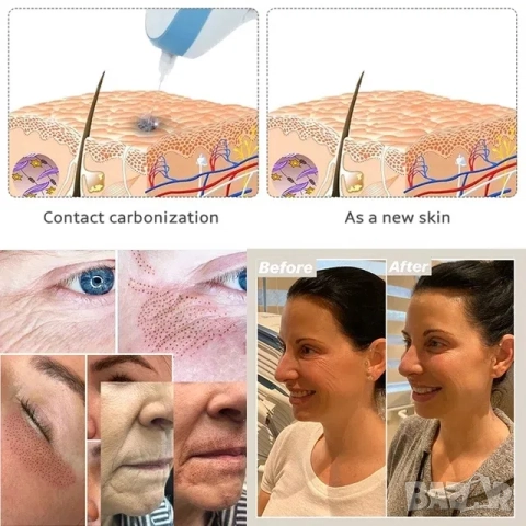 Козметичен Апарат за Фибробласт, Плазмолифтинг, Плазма Пен, лифтинг, снимка 4 - Козметични уреди - 52063932