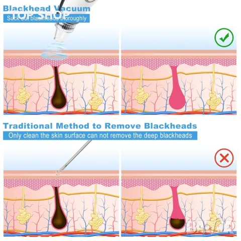 Vacuum blackhead remover премахване на черни точки, USB акумулаторен екстрактор на пъпки Tibobo, снимка 4 - Тримери - 48872982