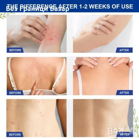 Нов Крем против гъбички, екзема и псориазис – бързо облекчение 100 гр, снимка 7 - Козметика за тяло - 48679787