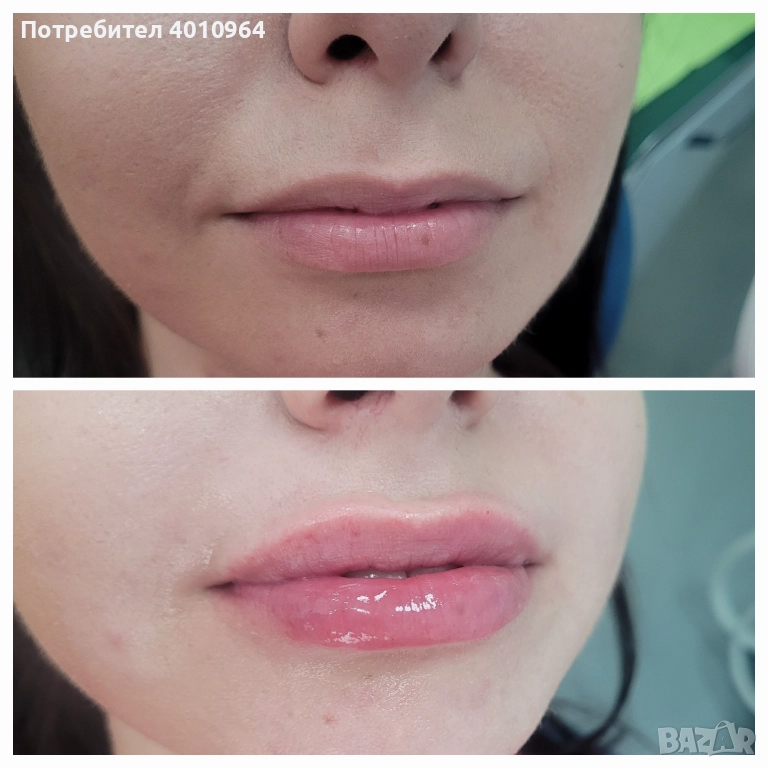  Дермални филъри, снимка 1