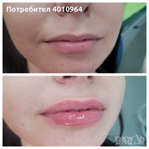  Дермални филъри