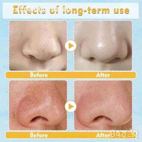 Нови 20 броя Пластири за черни точки – натурални, за всички типове кожа, снимка 3 - Други - 49863921