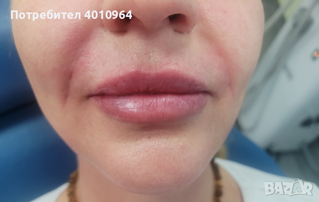 Дермални филъри, снимка 3 - Друго - 44934064