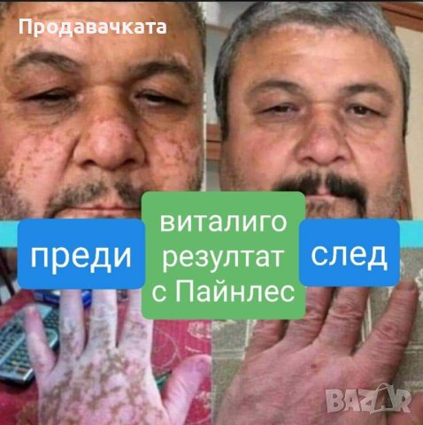 Пластири (Пейнлес) PAINLESS  налични! One More за определени заболявания, снимка 13 - Други - 36364317