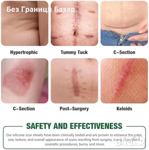 Нови Лепенки против белези – силикон, многократна употреба, безопасни, снимка 3 - Други - 49815364