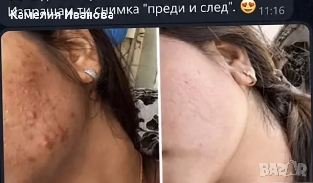 Крем против пъпки и петна, снимка 5 - Козметика за лице - 56425595