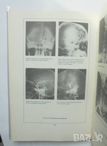 Книга Вспомогательные методы диагностики в невропатологии и нейрохирургии Атлас - Л. И. Сандригайло , снимка 3 - Специализирана литература - 40784554