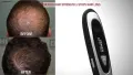 Лазерна четка за стимулиране растежа на коса и брада Power Grow Comb, снимка 2