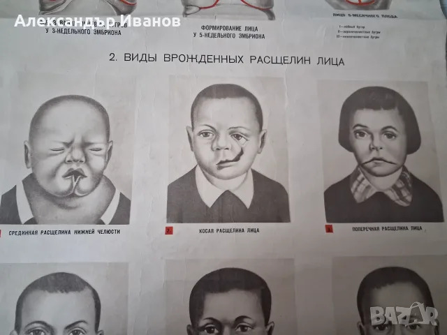Стара табела,табло "Дефекти на лицето" 1964 г., снимка 3 - Здраве, медицина и спорт - 56138553