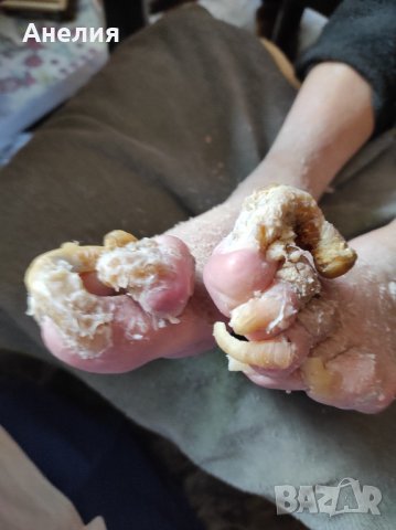 Медицински педикюр по домовете , снимка 15 - Медицински, стоматологични - 24454918